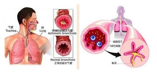 中医治疗气管炎