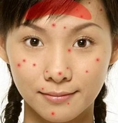 青春痘,全医堂,中医 青春痘,全医堂,中医