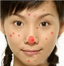 青春痘,全医堂,中医 青春痘,全医堂,中医