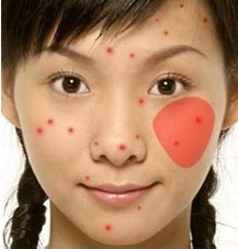 青春痘,全医堂,中医 青春痘,全医堂,中医