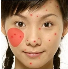 青春痘,全医堂,中医 青春痘,全医堂,中医