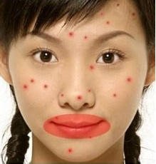 青春痘,全医堂,中医 青春痘,全医堂,中医