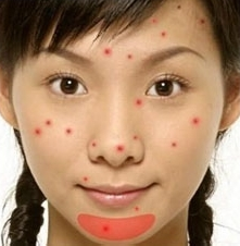 青春痘,全医堂,中医 青春痘,全医堂,中医