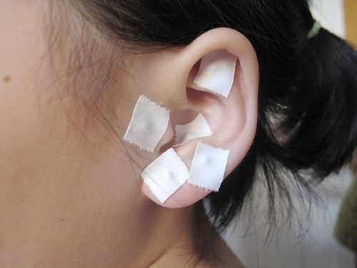 耳穴疗法,全医堂 耳穴疗法,全医堂